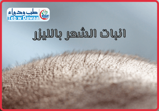 انبات الشعر بالليزر 004