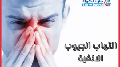 التهاب الجيوب الانفية 001