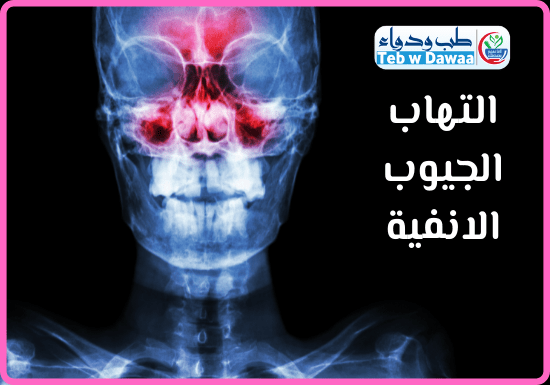التهاب الجيوب الانفية 003