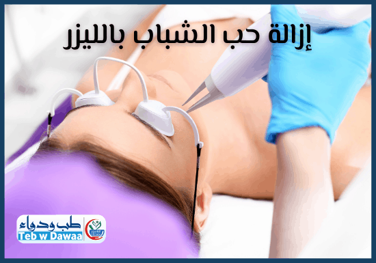 ازالة حب الشباب بالليزر 002