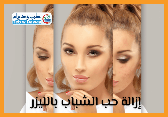 ازالة حب الشباب بالليزر 003