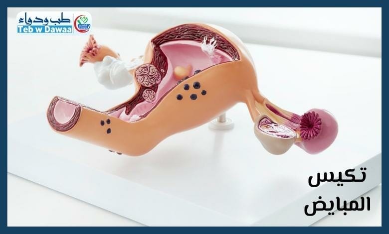 تكيس المبايض 002