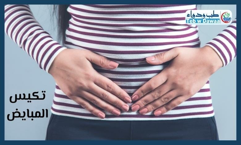 تكيس المبايض 003