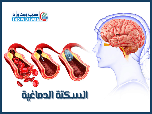 السكتة الدماغية 002