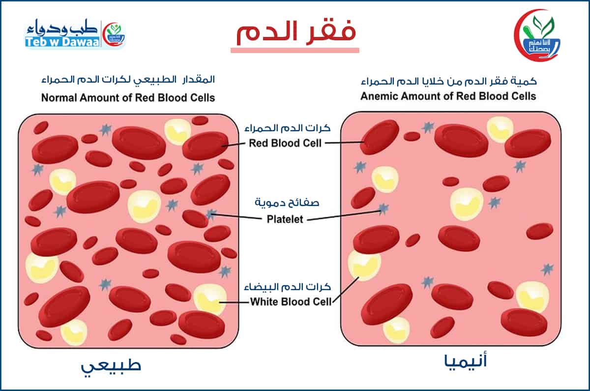 نقص الحديد 001
