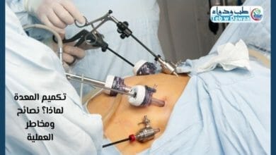 تكميم المعدة 001