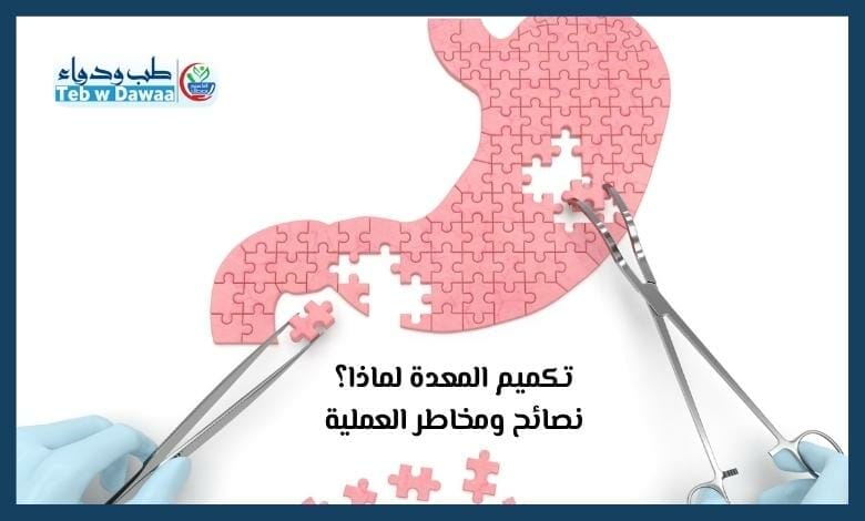 تكميم المعدة 003