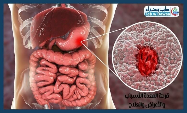 قرحة المعدة 002