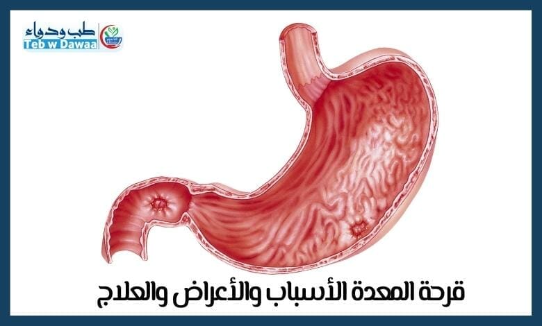 قرحة المعدة 003
